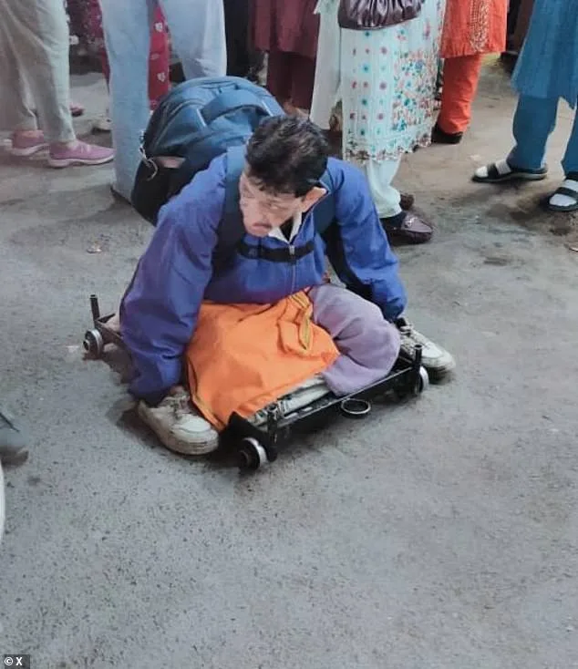 Officials in Indore Discover Contradiction While Assisting Beggar with Leprosy