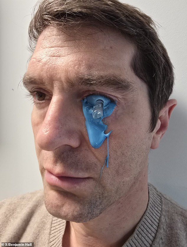 Fox News Correspondent Benjamin Hall Shares Glimpse Into Recovery From Ukraine War Injuries, Including Rebuild Of Artificial Lenses