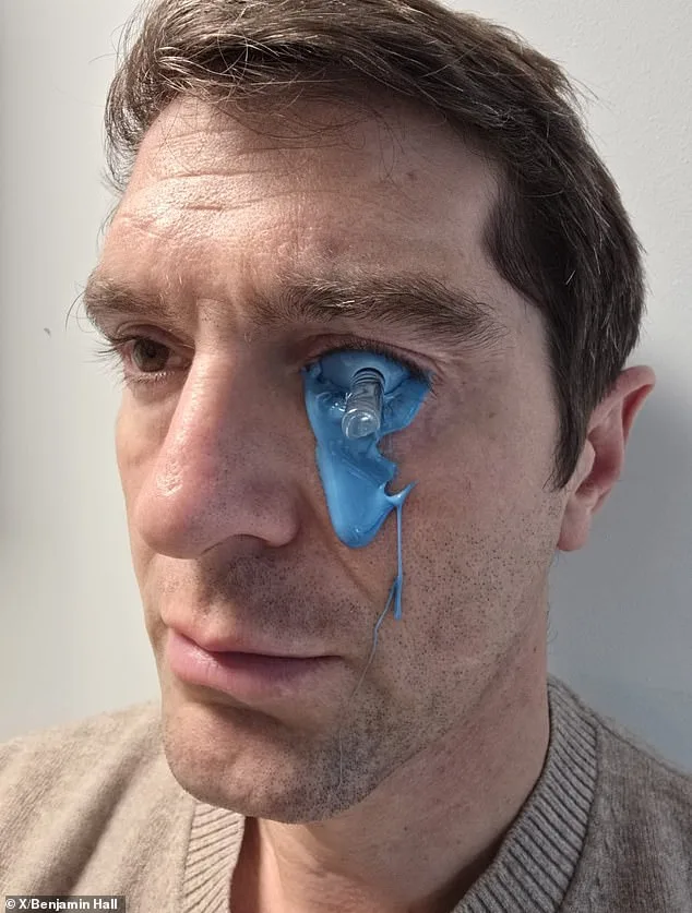 Fox News Correspondent Benjamin Hall Shares Glimpse Into Recovery From Ukraine War Injuries, Including Rebuild Of Artificial Lenses