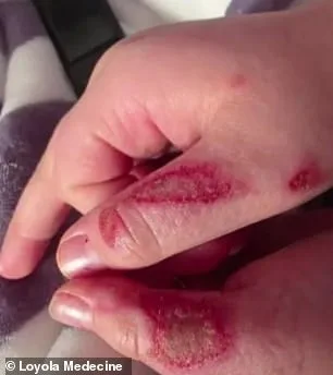 Nine-Year-Old Critical After Microwaving Needoh Cube in TikTok Trend Linked to Nationwide Injuries