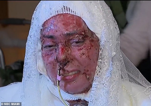 Devastating Grill Explosion: Faulty Gas Line Leaves Arianna Esquiline with Life-Changing Burns