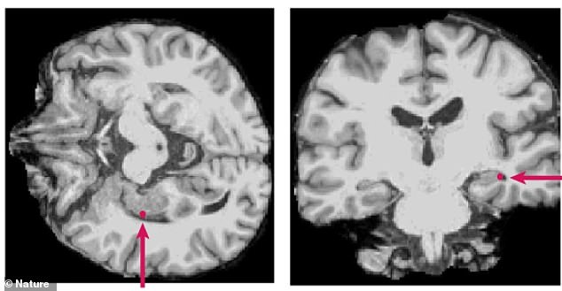Brain Processes Complex Language While Patients Remain Under Anesthesia