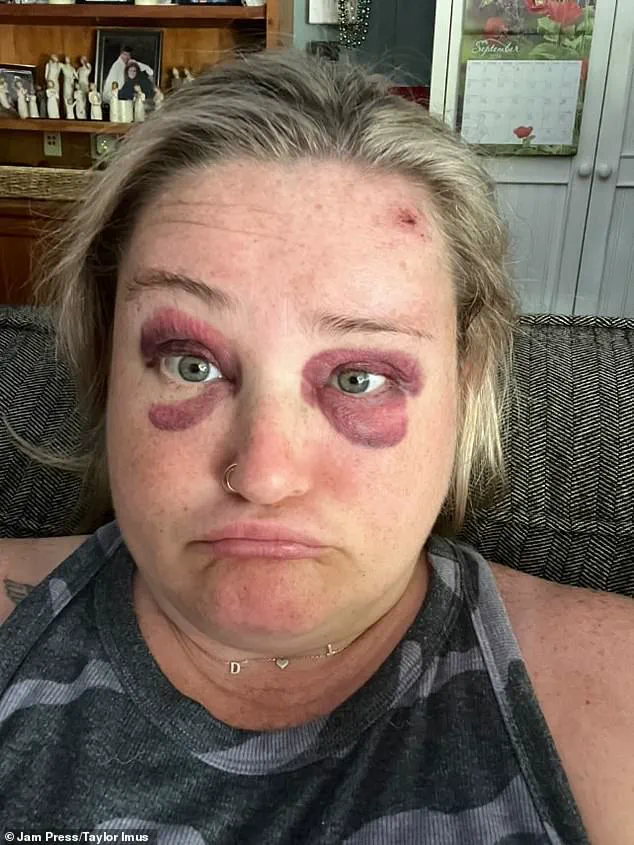 Michigan Woman's Wedding Day Disaster: Softball Injury Turns Face Black and Blue