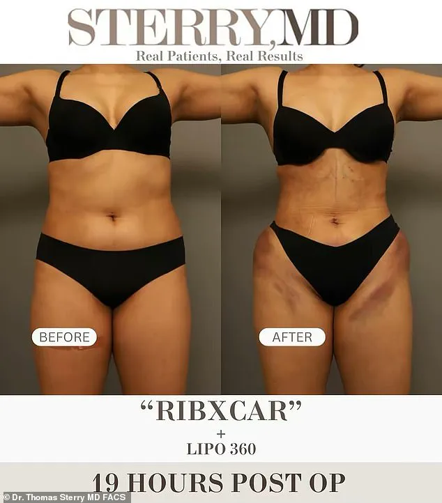 Women Turn to Controversial Rib Reduction Surgery for Social Media Perfect Waist