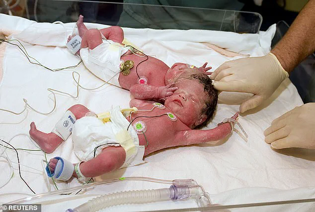 Neurosurgeon Claims Evidence of Souls Based on Clinical Observations of Brain-Damaged Patients and Conjoined Twins