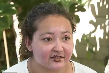 California Teen Severely Disfigured by Alcohol-Fueled Fire Pit Explosion While Making S'mores, Sparks Community Safety Alerts