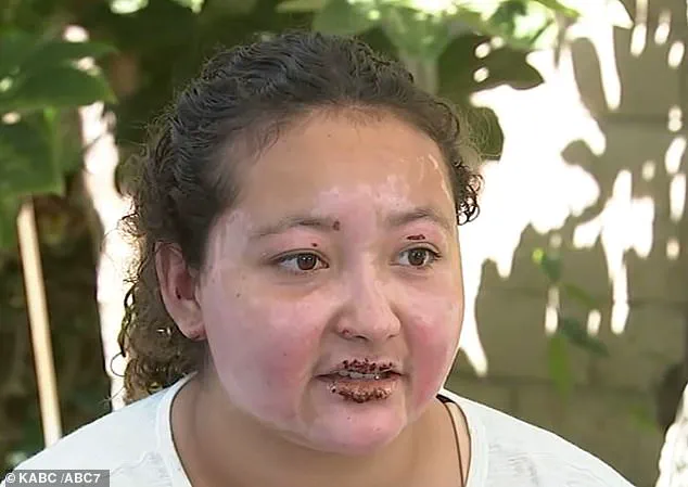 California Teen Severely Disfigured by Alcohol-Fueled Fire Pit Explosion While Making S'mores, Sparks Community Safety Alerts