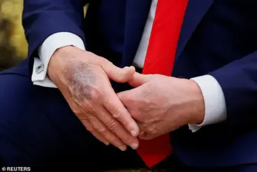 Breaking: White House Reveals Trump's Chronic Venous Insufficiency in July 2025 Memo, No Serious Arterial Disease Found