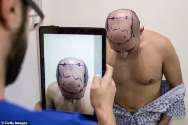 Hair Transplant Surgeon Warns of Severe Risks from Overseas Clinics