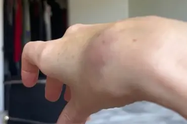 Breaking: TikTok Influencer with EDS Alleges Refusal of Assistance by American Airlines During Flight